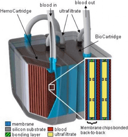 Image: A model of the implantable bioartificial kidney shows the two-stage system (photo courtesy University of California San Francisco).